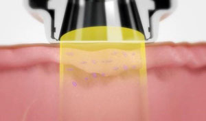 بهبود درمان رادیولوژی در جهت درمان سرطان پوست