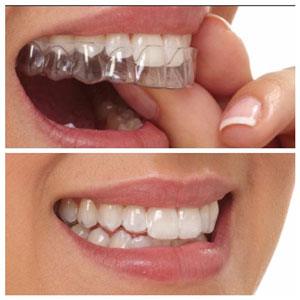 ارتودنسی نامرئی